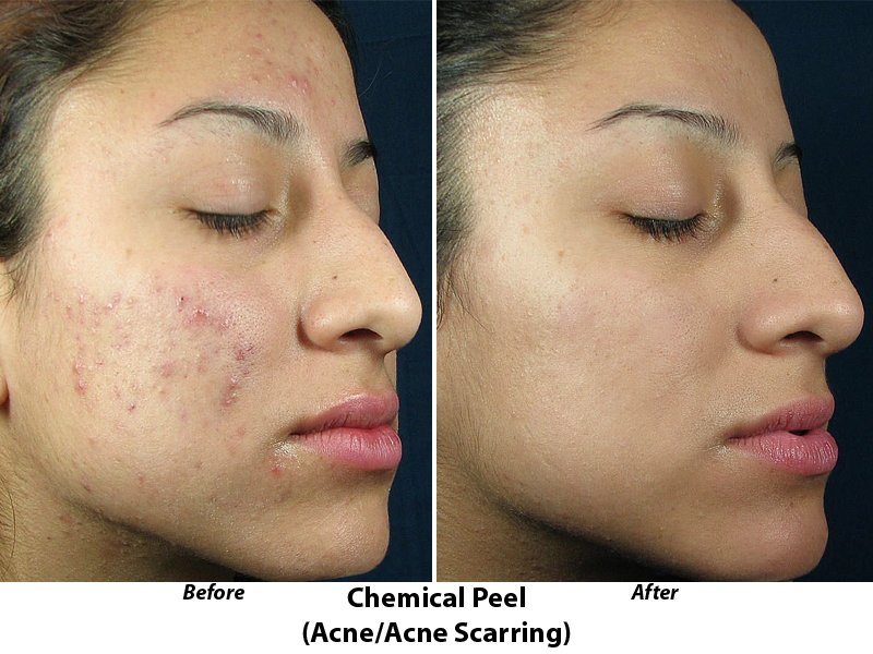 Medium facial chemical peels results