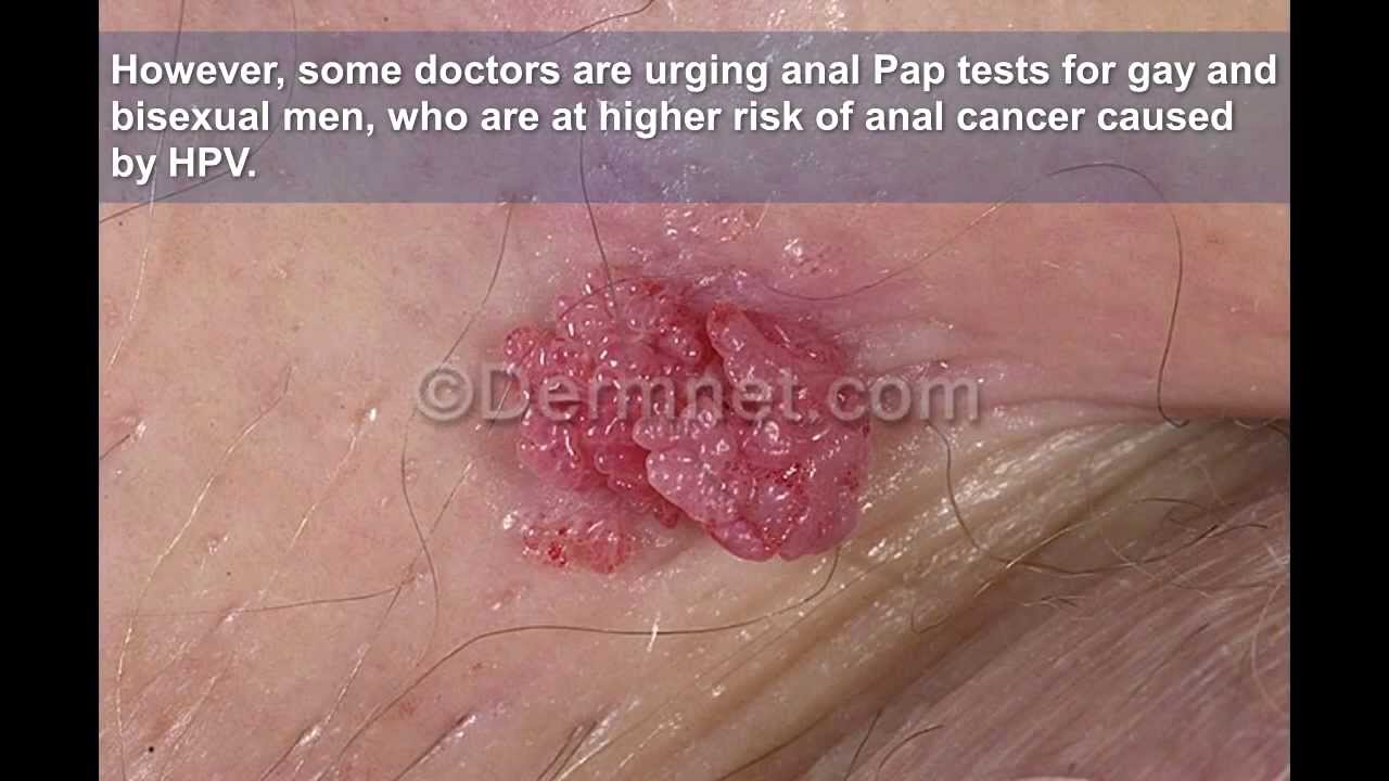 Genital in picture vagina wart