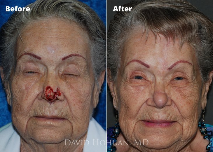 Cosmetic facial procedure