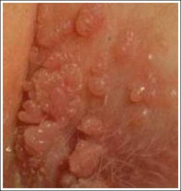 Hook reccomend Genital warts pictures on vulva