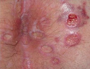 best of Sores the Herpes anus in