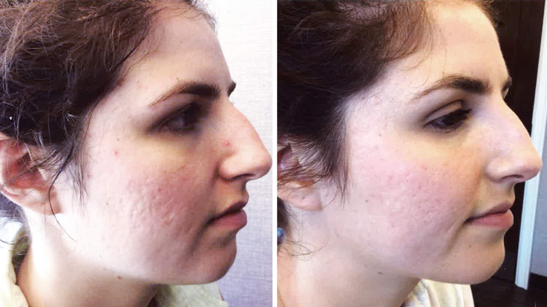 Sherry recommendet facial blemishes and scars Diminishing
