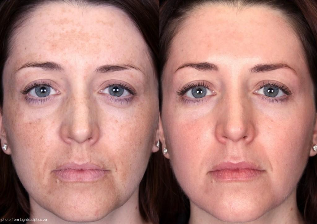Icecap recommendet chemical results facial Medium peels