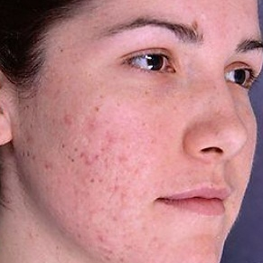 Diminishing facial blemishes and scars