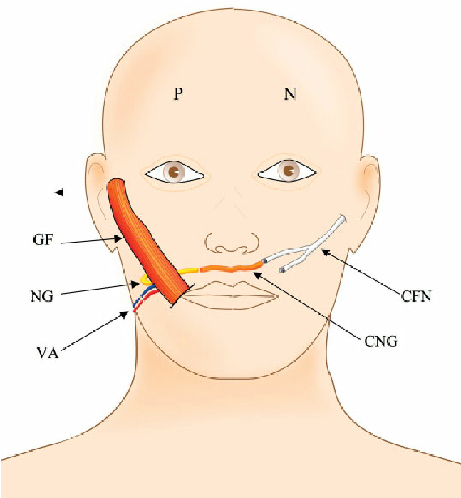 Poppins reccomend graft Temporalis facial