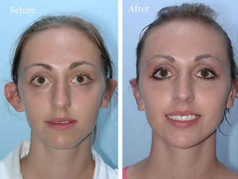 Don reccomend Cosmetic facial procedure