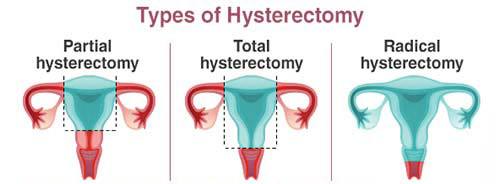 Hysterectomy effects on orgasm