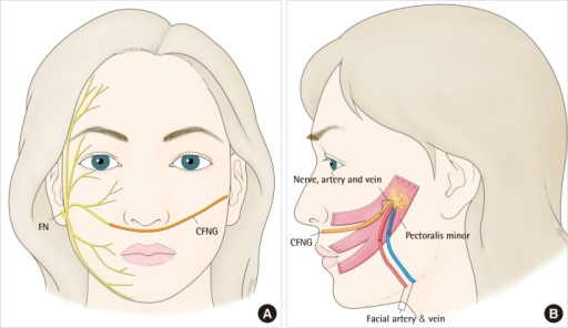 Brown E. reccomend Temporalis facial graft