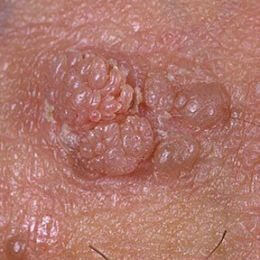 Mittens reccomend Genital in picture vagina wart