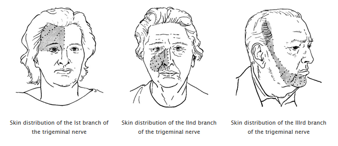 best of Sclerosis + pain Multiple facial