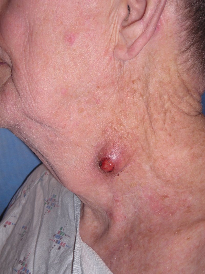 Mad D. recommend best of a facial cyst Removing