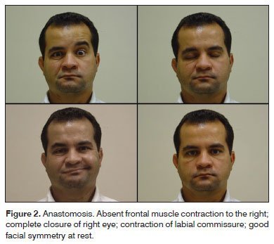 Temporalis facial graft